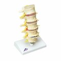 Toys4.0 Anatomical Model Vertebrae Degeneration, Stages of Prolapsed Disc TO299767